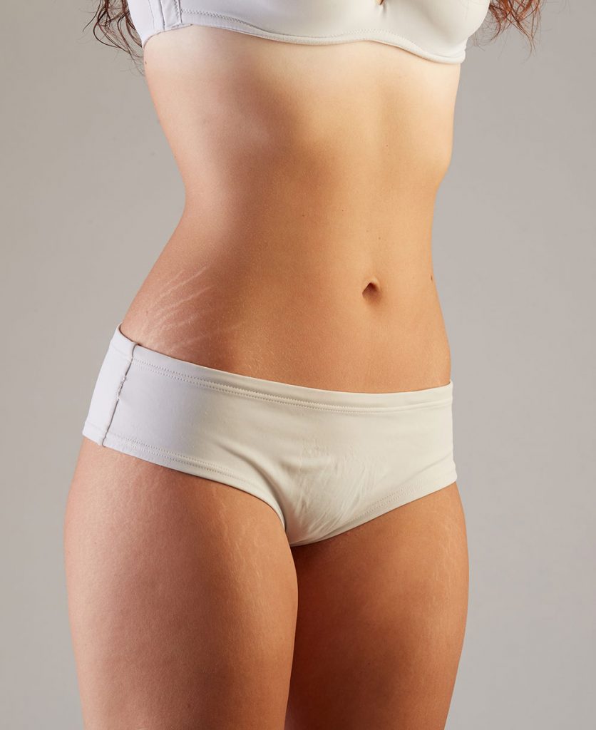 Mujer que presenta estrías en la parte derecha de su abdomen y en los muslos. Servicios que se encuentra en los corporales mas deseados